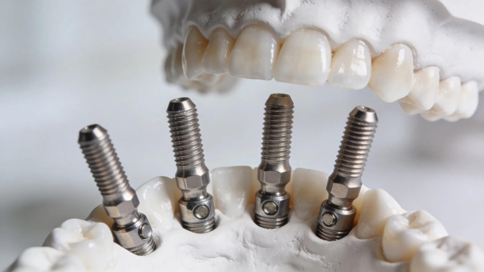 Close-up of All-On-4 dental implants showcasing their design and placement