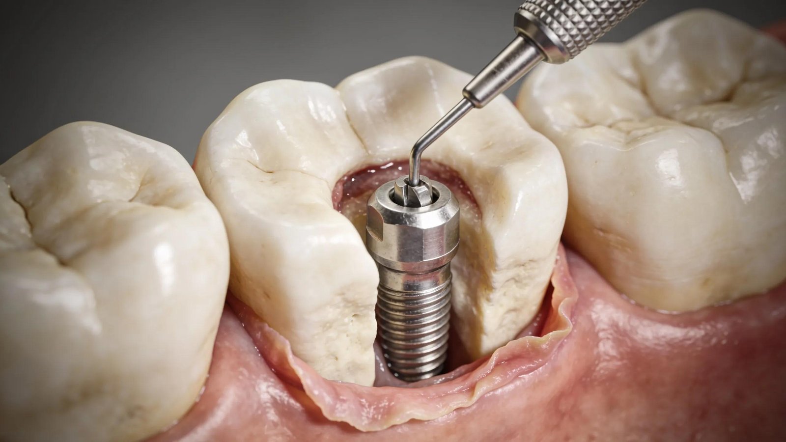 Dental implants being placed in a jawbone during a restoration procedure